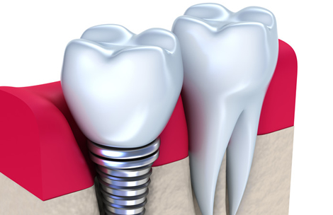 dental implant clinic tijuana